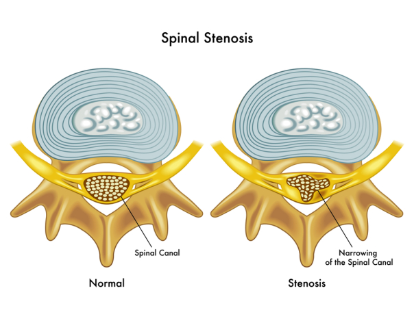 Spinal Stenosis Causes  Inherited vs. Acquired